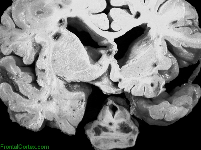 Multiple cavernous angiomas, coronal section of brain through basal ganglia and transverse section of pons.